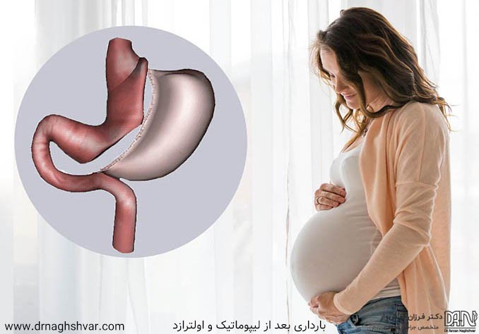 بارداری بعد از لیپوماتیک و اولترازد